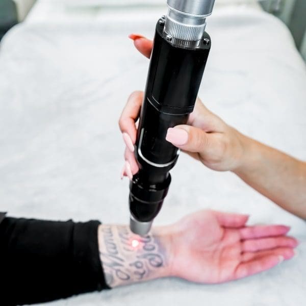 Remoção de Tatuagem a Laser